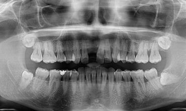 آیا ریشه دندانی که در سینوس است خطرناک است و نیاز به درمان فوری دارد؟
